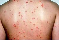 Les médicaments pour le foie au psoriasis