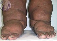 bilateral_elephantiasis.jpg