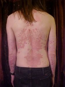 Les salles de bains avec le sel marin au psoriasis