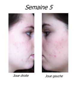 Photos - Le blog de mon-curacne Photos - Le blog de mon-curacne