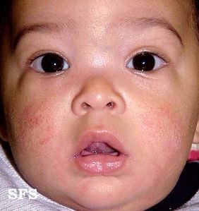 Le régime des gens avec atopitcheskim par la dermatite