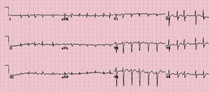 electrocardiogramme.jpg