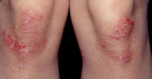 Le psoriasis les signes du rétablissement