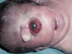 SINDROME-DE-PATAU.jpg