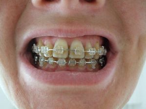 J+3 mois dents