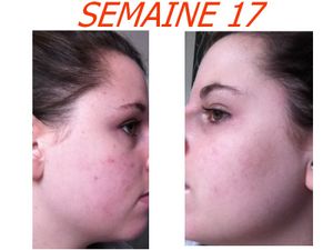 Tetracycline acné avis - Can i take zoloft 2 times a day Tetracycline acné avis - Can i take zoloft 2 times a day