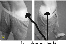 Le traitement de lépine dorsale par la bouteille avec leau
