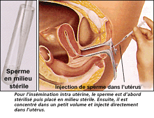 Insémination artificielle pour femmes célibataires