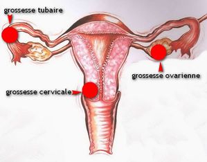 Grossesse_extra_uterine.jpg