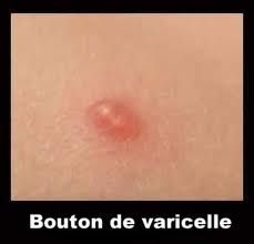 La soude des traces des boutons sur la personne