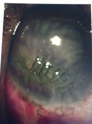 Oeil
