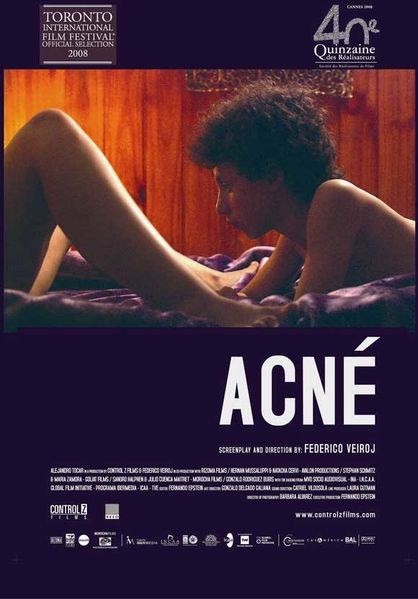 ACNE.jpg