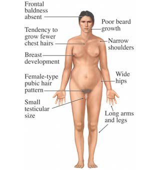 Klinefelter_Syndrome-3.jpg
