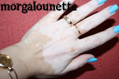morgalounette et vitiligo morgalounette et vitiligo