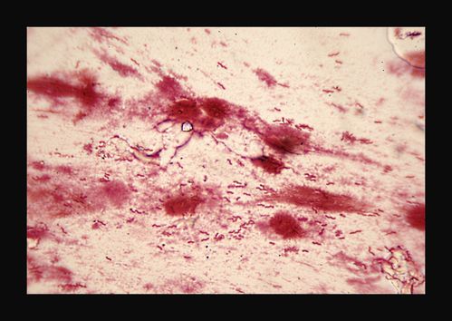 helicobacter pylori2
