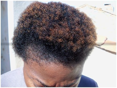 Alopecie-dessus.jpg
