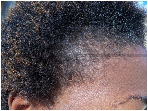 Alopecie.jpg