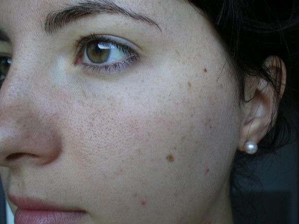 La vitamine e les taches de pigment