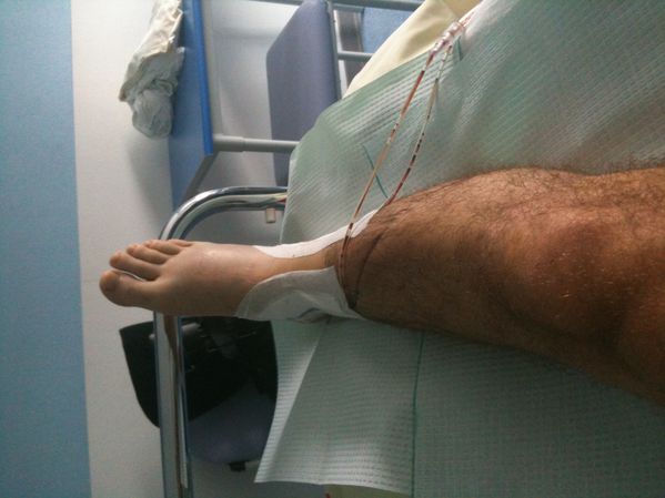 Fracture-tibia-peronne-D 0412