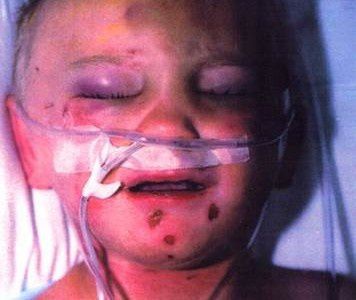 Scorbut-chez-un-enfant.jpg