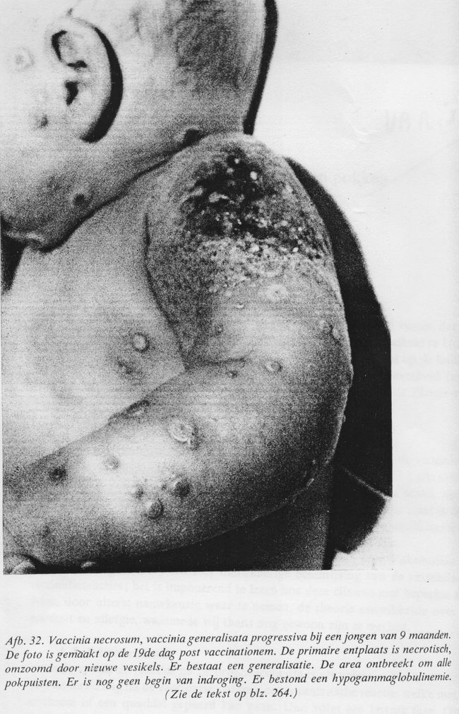 variole-et-polio-2.jpg