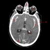 hemorragie-sous-arachnoidienne-3 fs