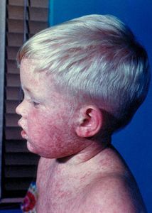 measles-rougeole.jpg