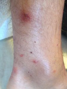 Pustules-3