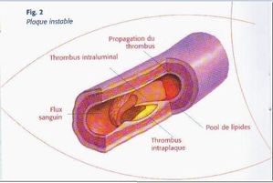 plaque-d-atherome.JPG