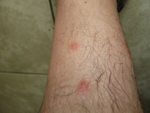 Pustules-1