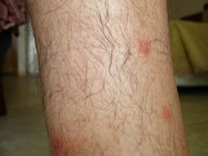 Pustules-2