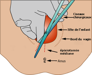 Copie_de_Medio-lateral-episiotomy.png