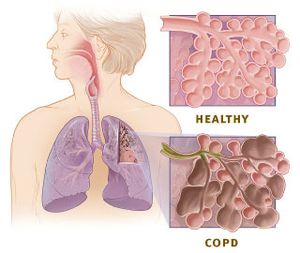 Copd_versus_healthy_lung.jpg